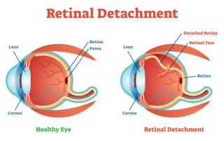 Retinal Detachment | medical illustration showing Retinal Detachment