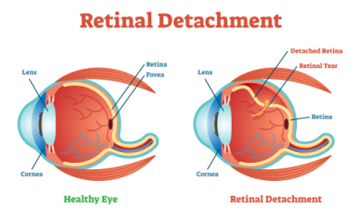 Retinal Detachment | medical illustration showing Retinal Detachment