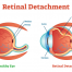 Retinal Detachment | medical illustration showing Retinal Detachment