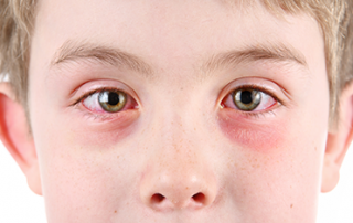 pink eye | conjunctivitis | photo of boy with pink eye