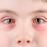 pink eye | conjunctivitis | photo of boy with pink eye