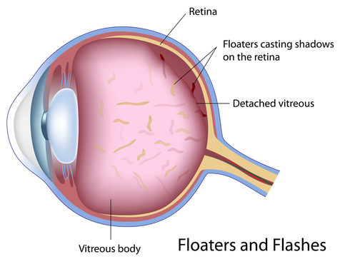 Floaters and Spots | medical illustration showing Floaters and spots