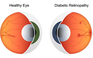 low vision | diagram showing a healthy eye vs. a diabetic eye