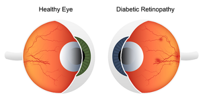 low vision | diagram showing a healthy eye vs. a diabetic eye