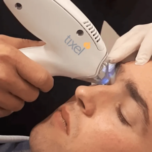 Tixel i non-invasive thermomechanical treatment