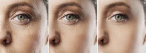 Tixel Delicate Skin rejuvenation