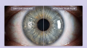 Tixel i Dry Eye treatment
