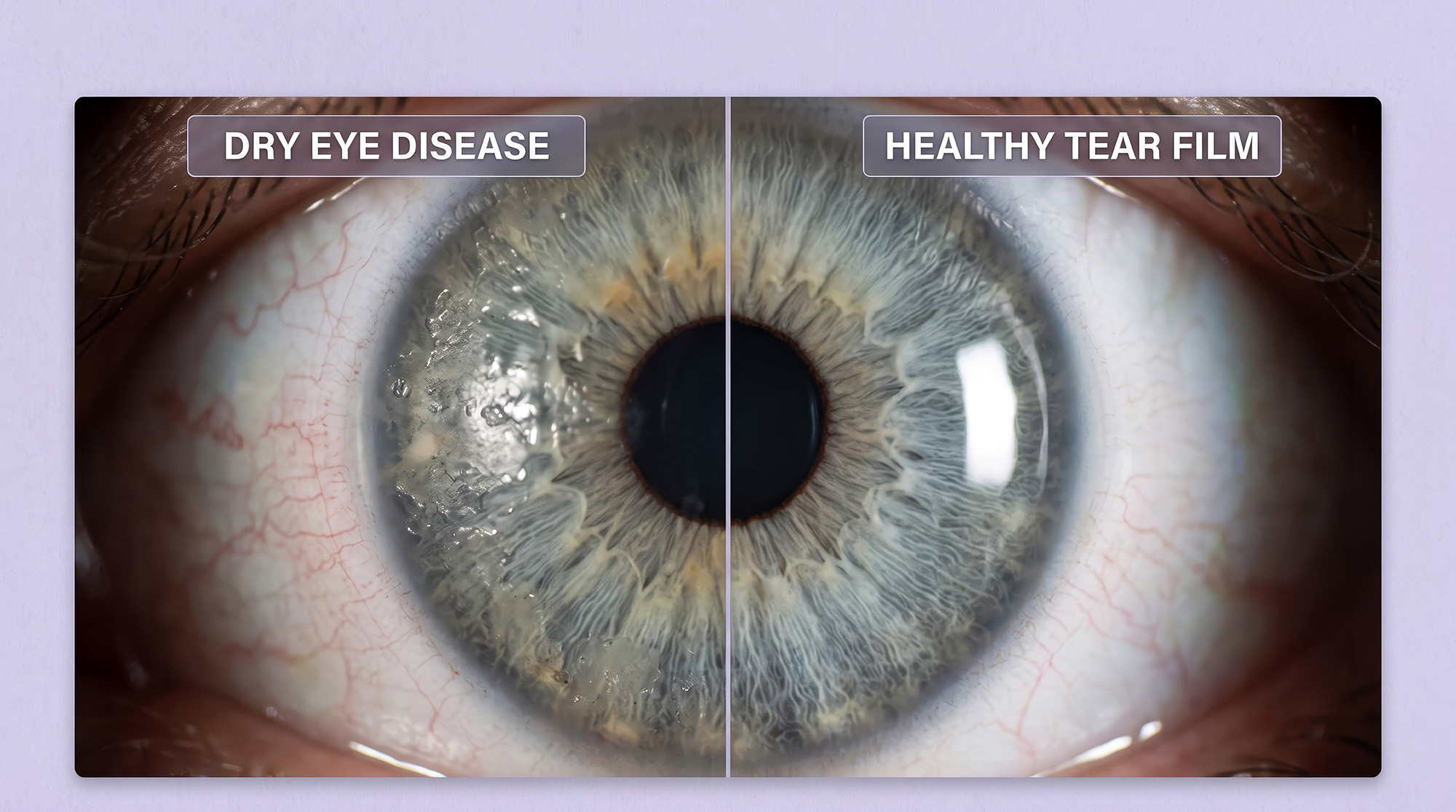 dry eye_healthy eye